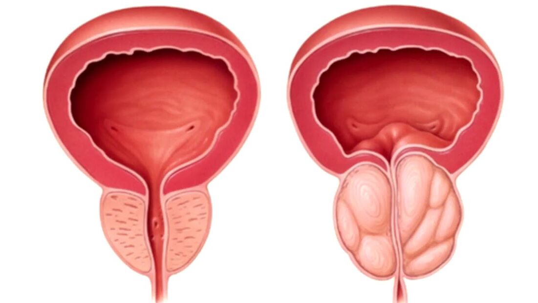 vesela un slima prostata