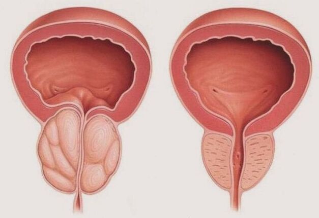 vesela un iekaisusi prostata ar prostatītu