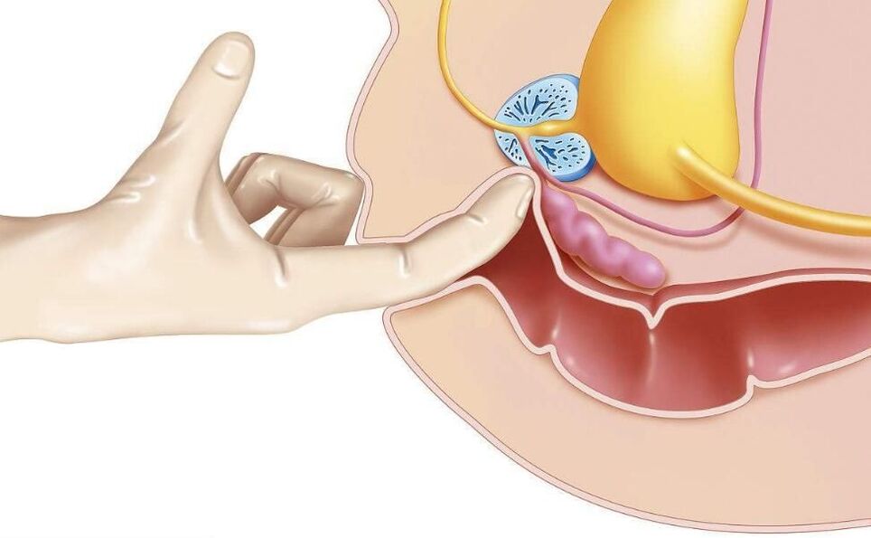 prostatas masāža prostatīta ārstēšanai