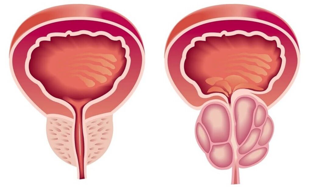 vesela un slima prostata